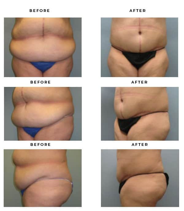 Abdominoplasty · Before & After Results · Rancho, Inland Empire