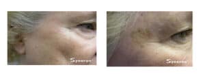 SRA (IPL-RF) Remove vessels, sun damage, rosacea, skin spots with laser treatments in Rancho Cucamonga at Gemini Plastic Surgery