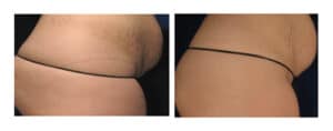 Get sublative skin rejuvenation for stretch marks in Rancho Cucamonga at Gemini Plastic Surgery