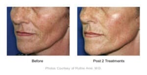 Sublime laser treatments to reduce fine lines in Rancho Cucamonga. Available at Gemini Plastic Surgery