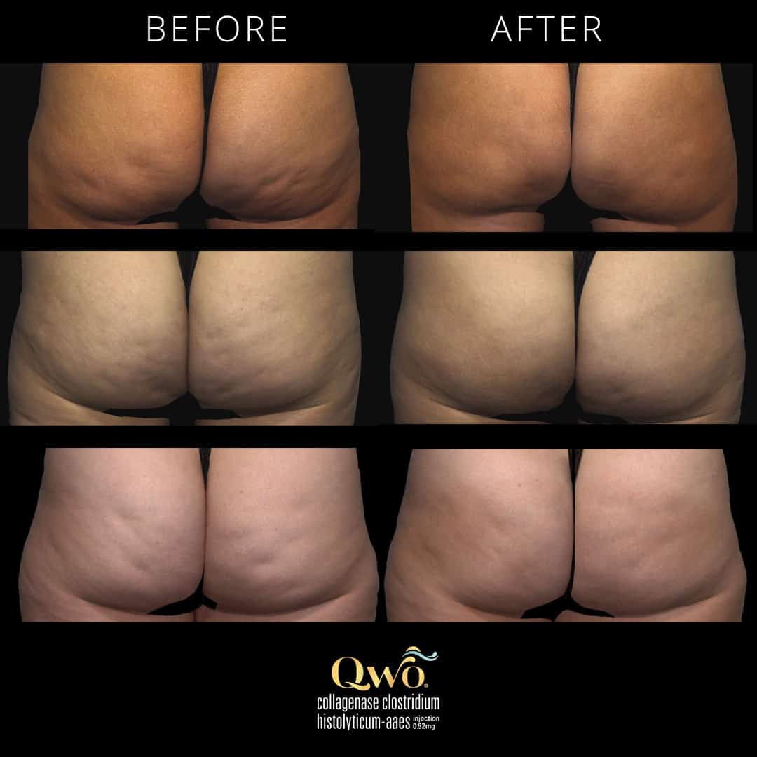 Cellulite treatment Qwo gets rid of cellulite with injection