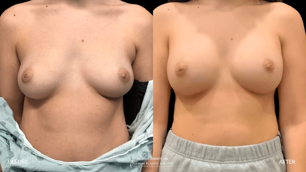 Best Breast Implant Before & After Photos for the best plastic surgeon in Southern California · Della Bennett, MD