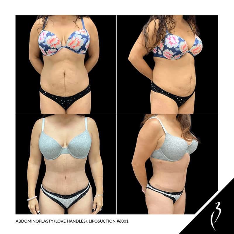Stomach and Abdomen Liposuction Before and After Photos - Palm Clinic